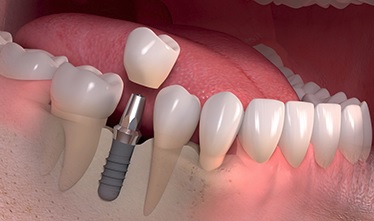 We are the best dental implant here in Sydney.