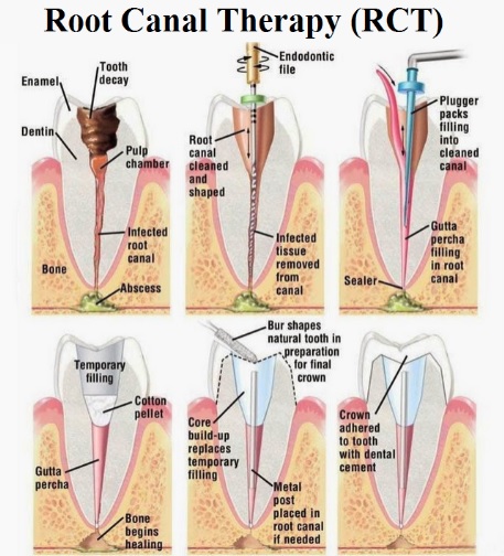 Root canal treatment in Sydney.