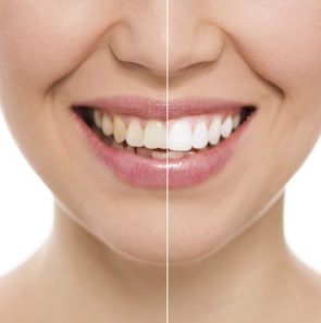 We provide teeth whitening here in our Sydney clinic.