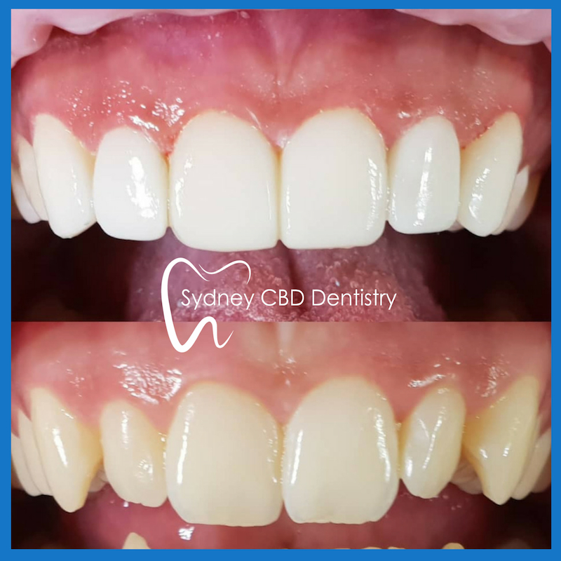 Dental veneers in Sydney