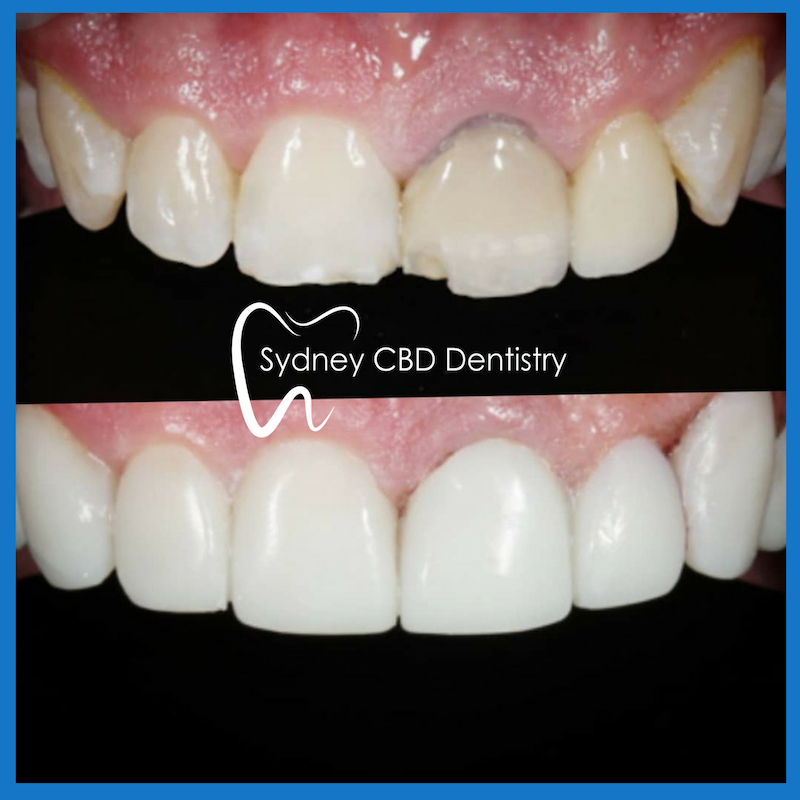 Best dentist for veneers in Sydney