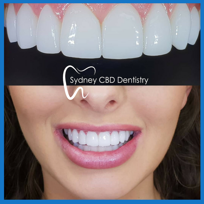 Dental veneers in Sydney
