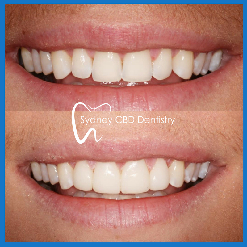 Veneers in Sydney