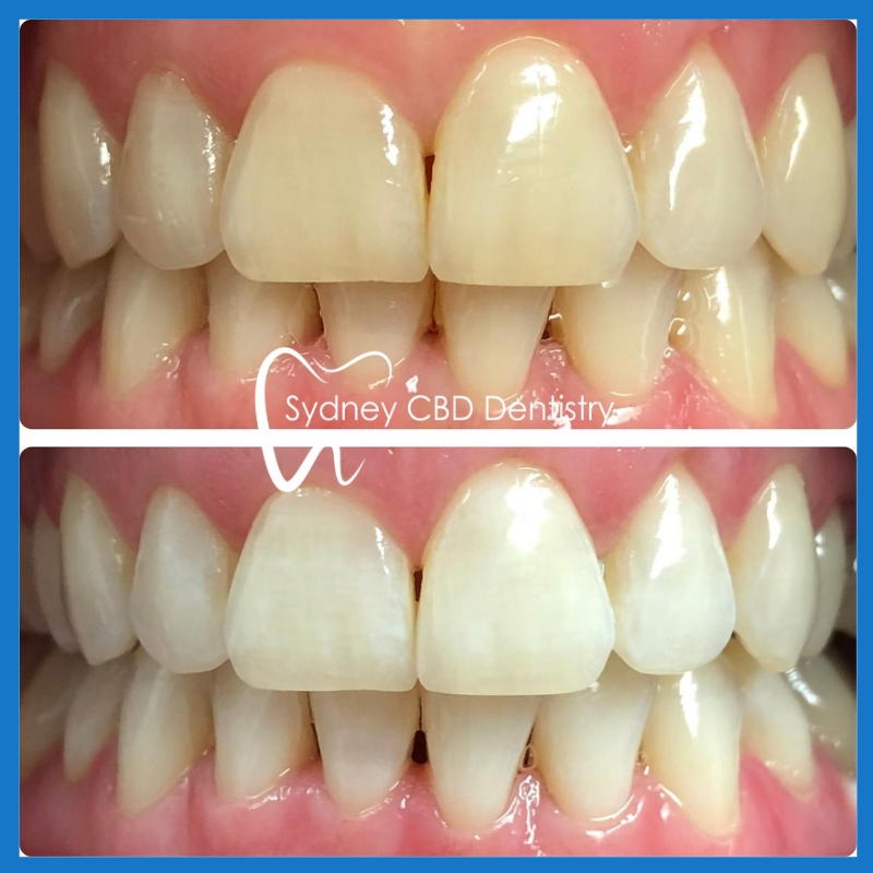 Teeth Whitening Dentist Cost Sydney - TeethWalls