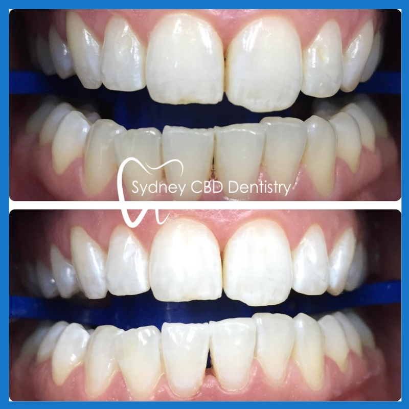 Teeth whitening in Sydney