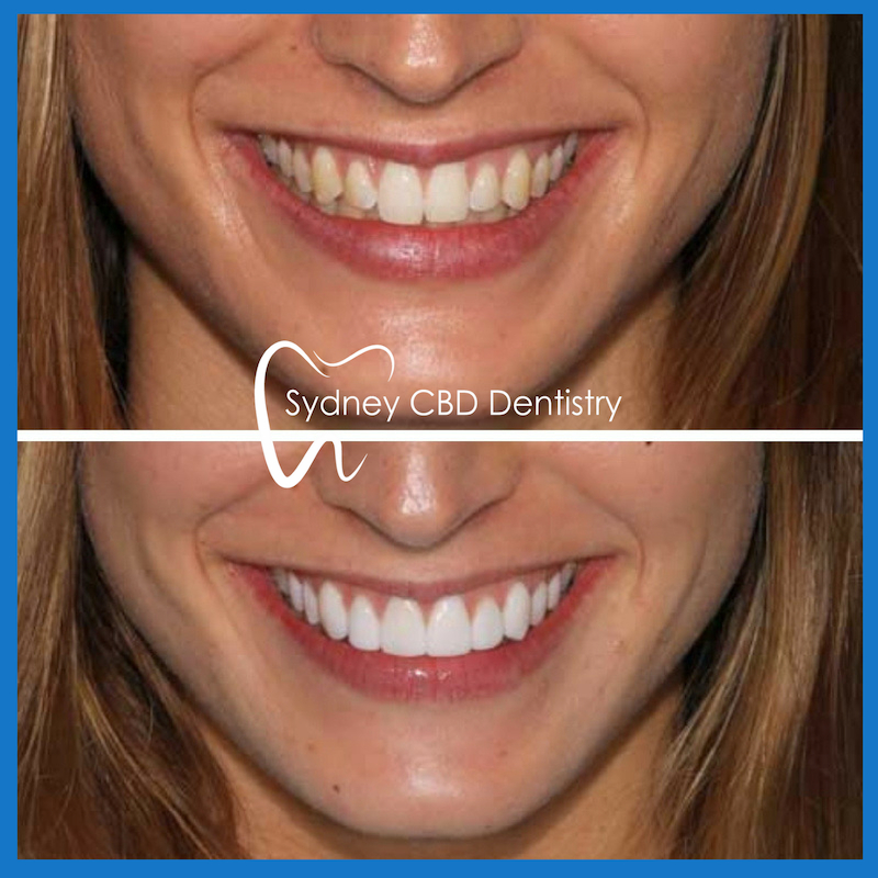 Veneers in Sydney
