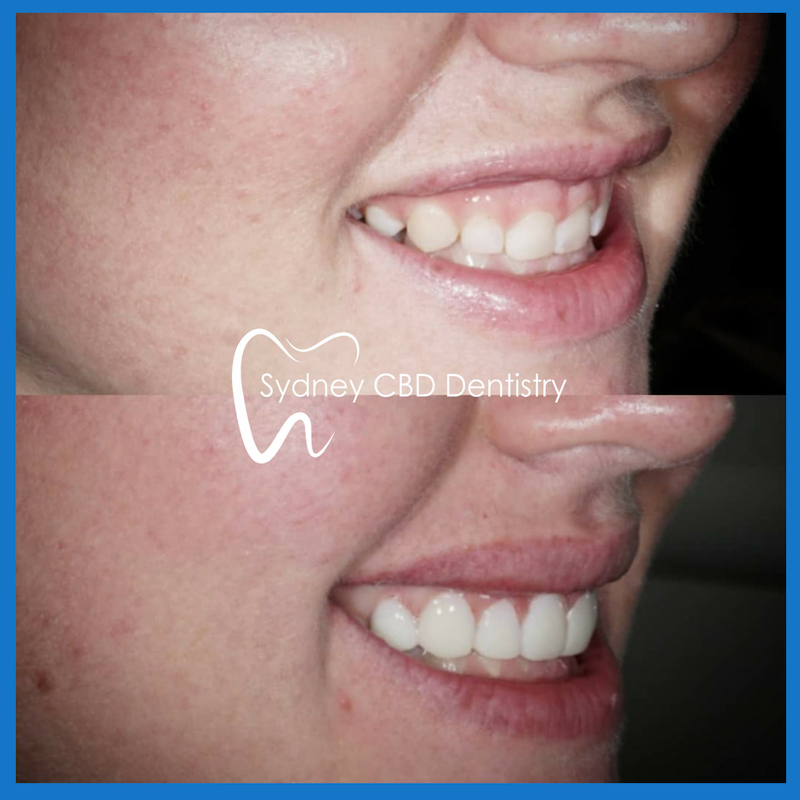 Affordable dental veneers in Sydney