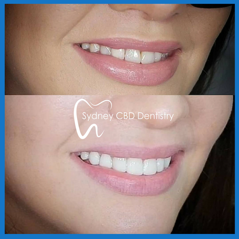 Best veneers in Sydney