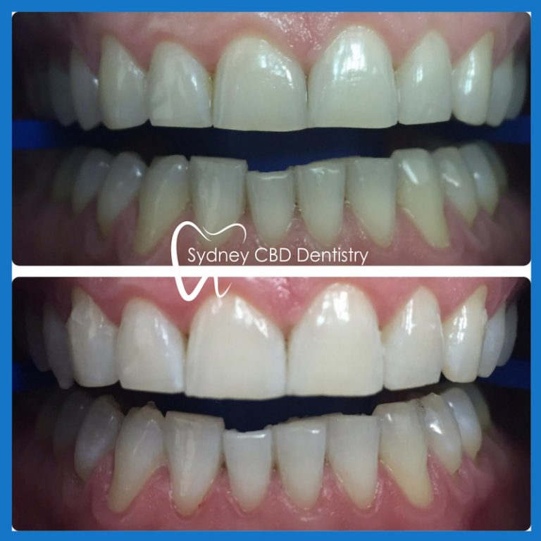 Teeth Whitening Sydney Sydney CBD Dentistry