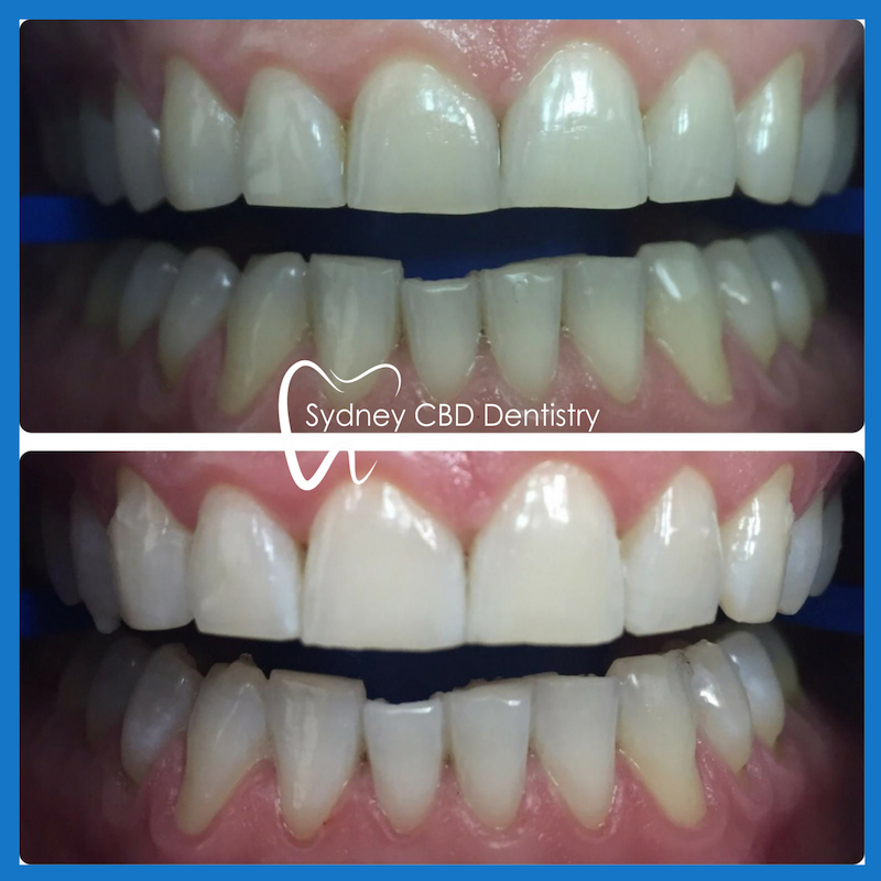 Affordable teeth whitening in Sydney