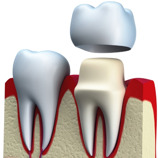 Dental Crown in Sydney