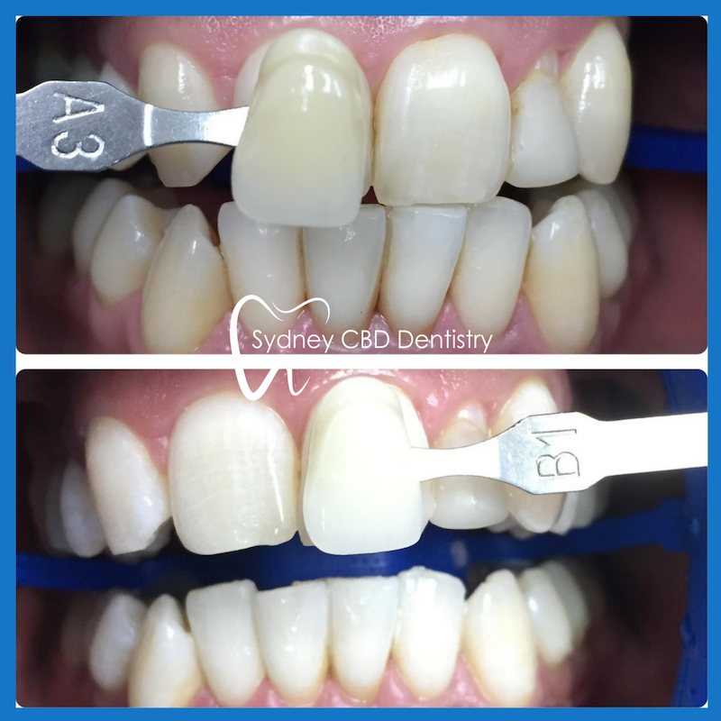 Teeth whitening in Sydney