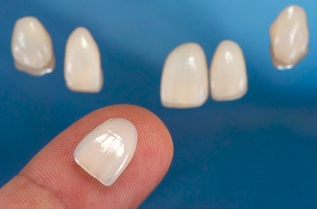 Porcelain Veneers in Sydney