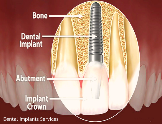 Dental Implants