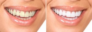 We are the best dentistry for teeth whitening in Sydney.