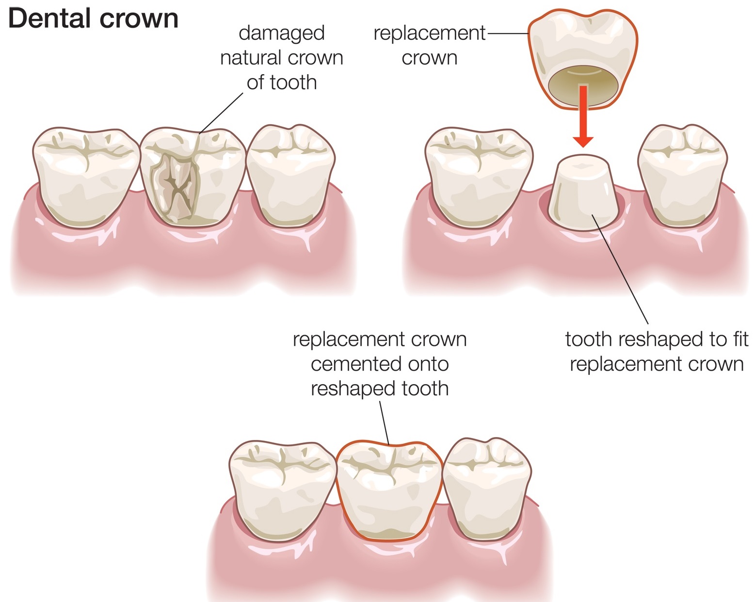 We are the best dentistry for dental crowns in Sydney CBD.