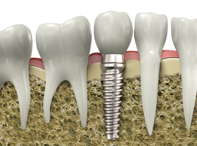 We have the best dental implants in Sydney.