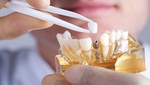 We are the best dentistry for dental implants in Sydney CBD.