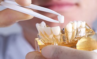 We are the best dentistry for dental implants in Sydney CBD.
