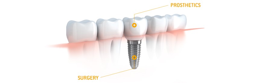We are the best dentistry for dental implants in Sydney.