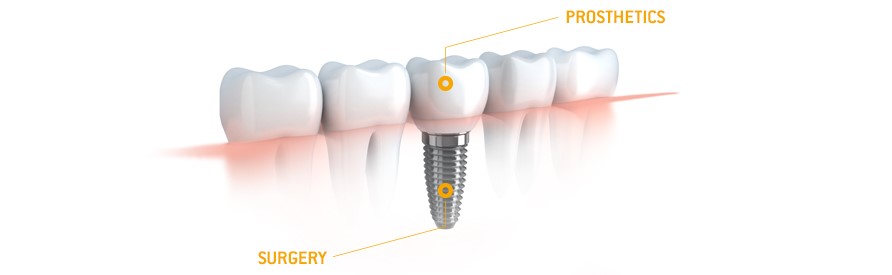 We are the best dentistry for dental implants in Sydney.