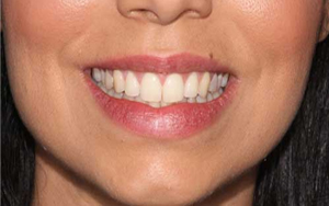 A case before the teeth whitening procedure in Sydney.