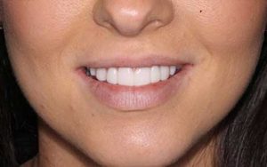 This perfect set of teeth is made possible with our high quality dental services in Sydney.