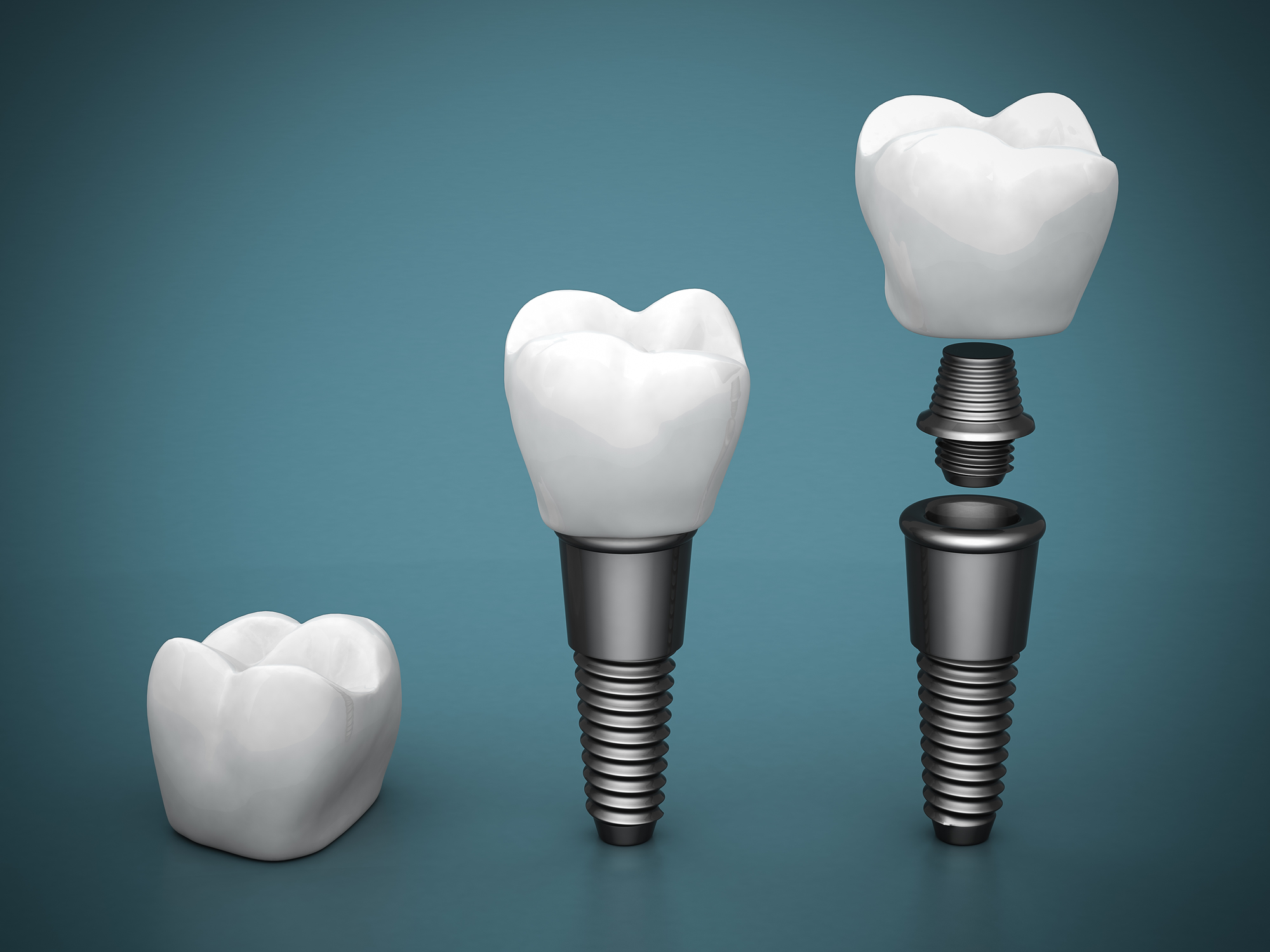 We are the best in dental implants here in Sydney.