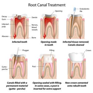 We are the best in root canal therapy here in Sydney.