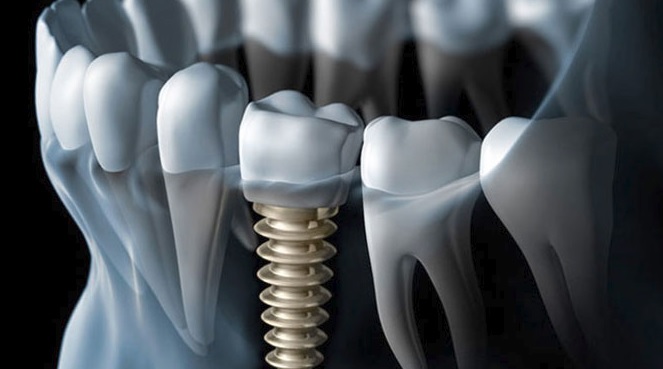 The best dental implants in Sydney.