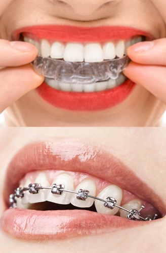 Braces cost in Sydney