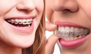 We have affordable braces cost here in our Sydney clinic.