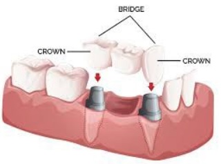 Dental Crowns and Bridges available here in our Sydney clinic.
