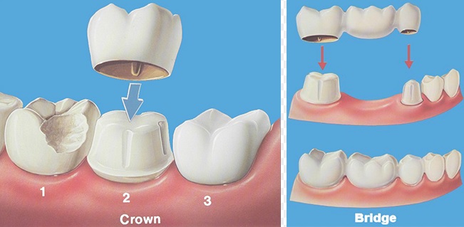 Dental Crowns and Bridges here in Sydney.