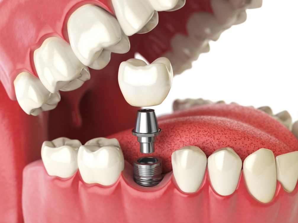 Dental Implant available at our clinic here in Sydney.