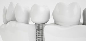 Dental Implant Cost in Sydney