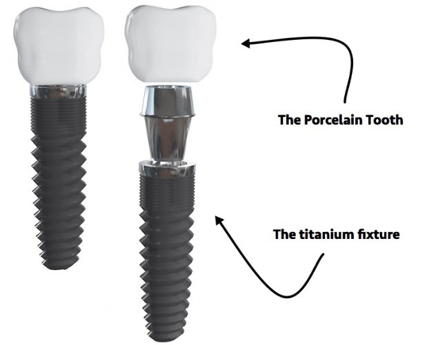 Dental Implant Cost here in Sydney