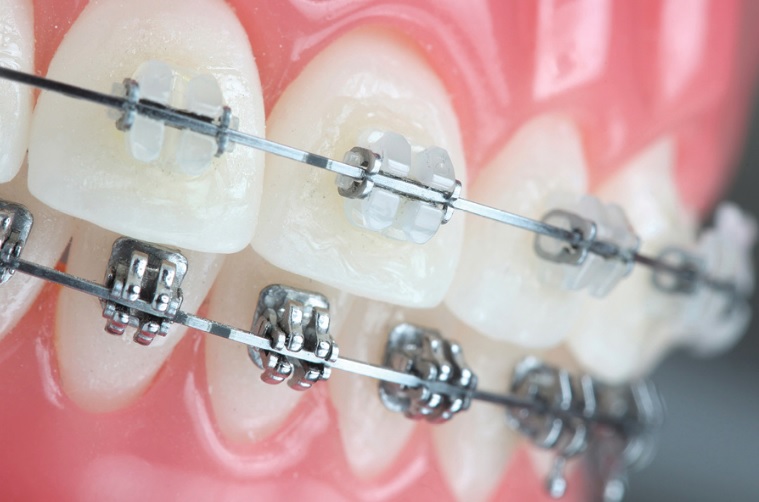 Orthodontic Treatment Process