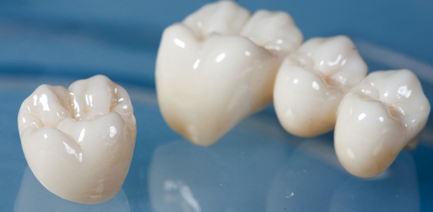 Porcelain Dental Crown in Sydney