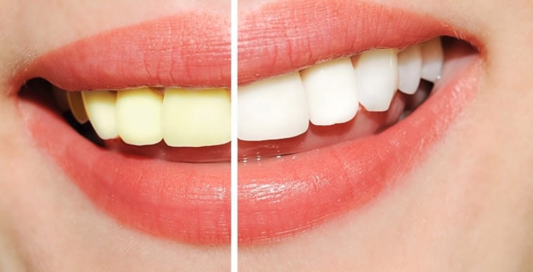 Teeth whitening in Sydney