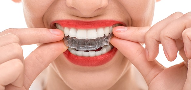 We are Invisalign Platinum Provider in Sydney