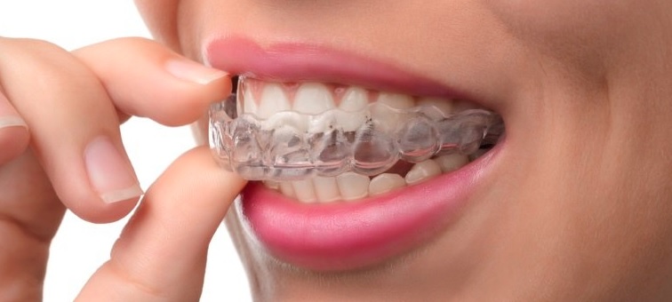 Invisalign Platinum Provider in Sydney