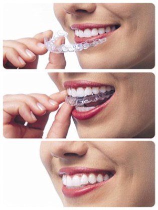 Invisalign cost in Sydney