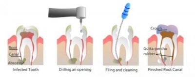 Root Canal Treatment in Sydney