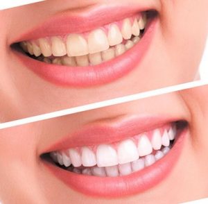 We have a special offer on teeth whitening here in our Sydney clinic.