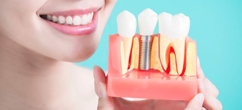 We offer affordable dental implants in Sydney