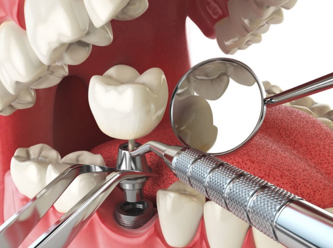 We have the best dental implant in Sydney