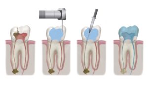 We offer affordable root canal therapy in Sydney.