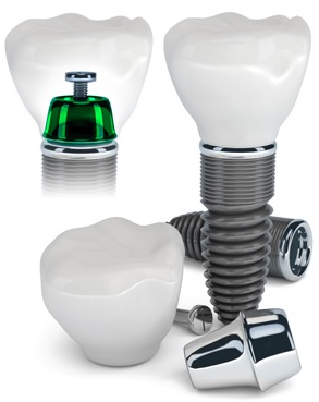 We offer affordable dental implants in Sydney