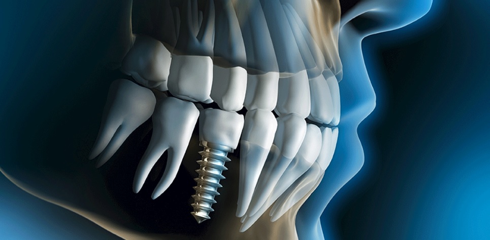 We have the best dental implant in Sydney